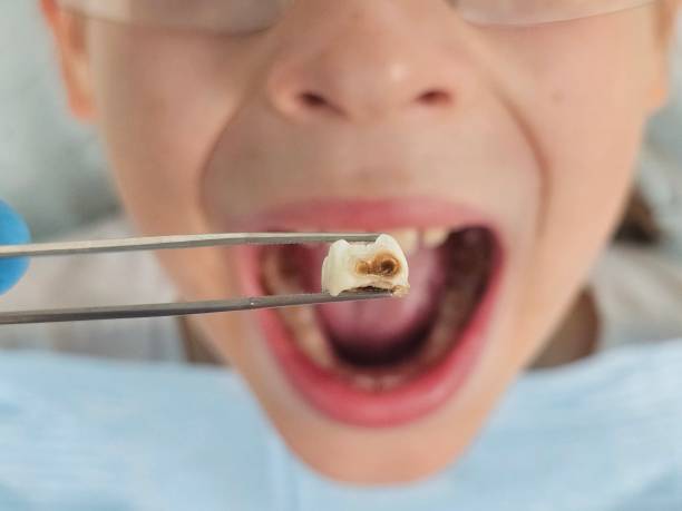 Best Emergency Wisdom Teeth Removal in Thorndale, TX