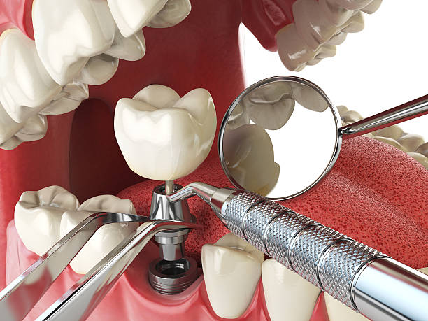Best Emergency Tooth Extraction in Thorndale, TX